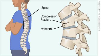 Compression Fracture Lumbar