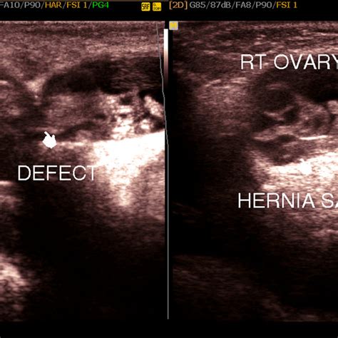 Lumbar Hernia Ultrasound