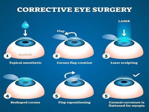 What is LASIK Surgery? Know its cost & Treatment