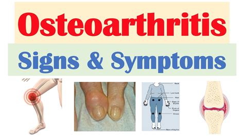 What'S The Symptoms Of Osteoarthritis? Best 16 Answer ...