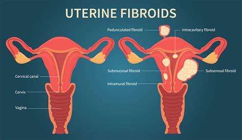 Schéma De Fibromes Utérins Sur Le Fond Bleu Foncé Vecteurs libres de ...