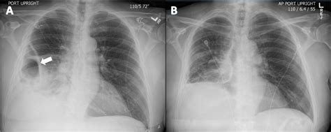 Cureus | An Unusual Case of Cavitary Lung Lesion and a Brief Review of ...