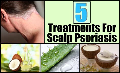 5 Best And Effective Ways For Scalp Psoriasis Treatments | Natural Home ...