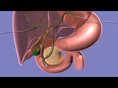 Your Biliary Drain - YouTube