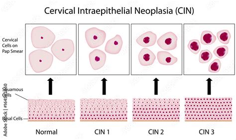 Cervical dysplasia stages and pap smear test Stock Illustration | Adobe ...