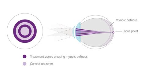 MiSight for Myopia Control - Agincourt Eye Care