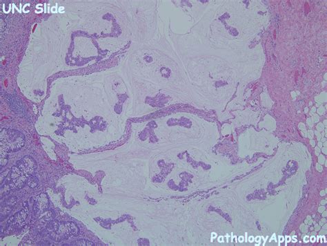 mucinous adenocarcinoma pathology