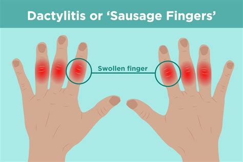 What Is Dactylitis? Understanding Causes, Symptoms, and Treatments