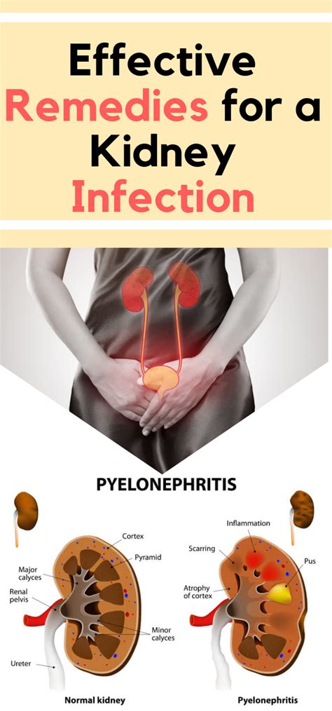 Kidney Infection