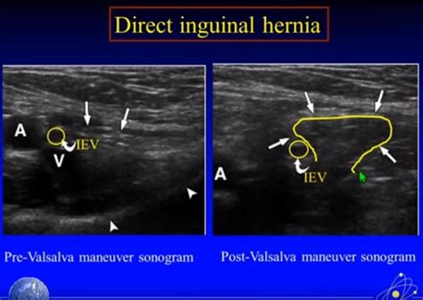 Pin by Stelios Daskalogiannis on hernias- groin | Diagnostic medical ...