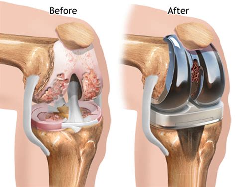 Total Knee Replacement in Mumbai - Dr. Ashit Shah