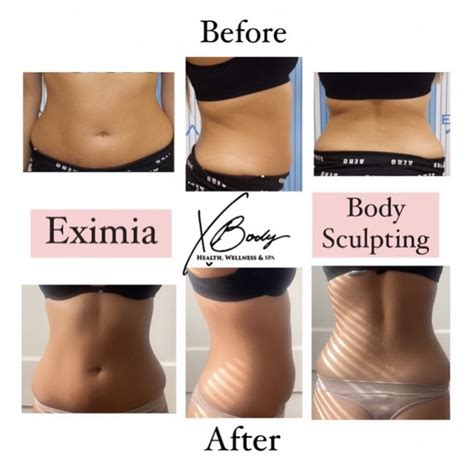 Discover Our Eximia Treatments | XBody Health & Wellness