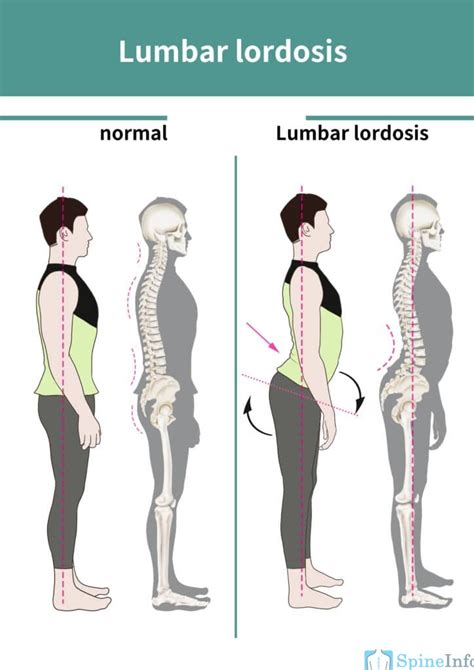 Lordosis: Definition, Causes, Symptoms, Diagnosis, and Treatment ...