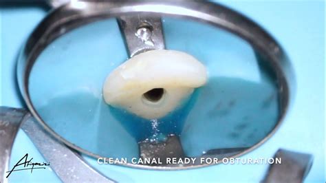 Root canal treatment on the maxillary central incisor (tooth 21) - YouTube