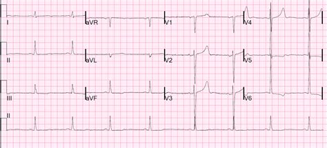 Dr. Smith's ECG Blog: Bradycardia, SOB, in a Dialysis Patient