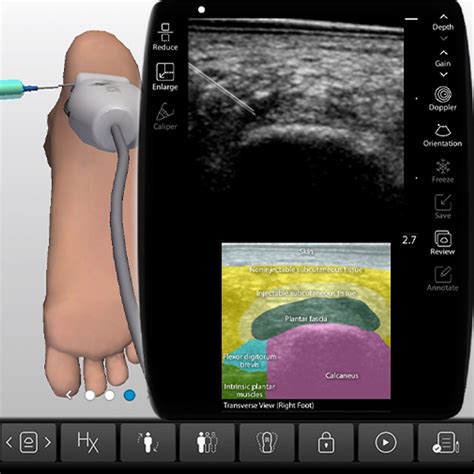 Plantar Fascia Ultrasound-Guided Injections Procedure Module