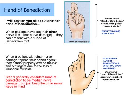 Hand Of Benediction Vs The Claw Hand The Ulnar Paradox] | atelier-yuwa ...