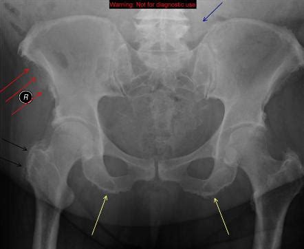 Ischial Tuberosity Syndrome Pain, Pictures, Treatment