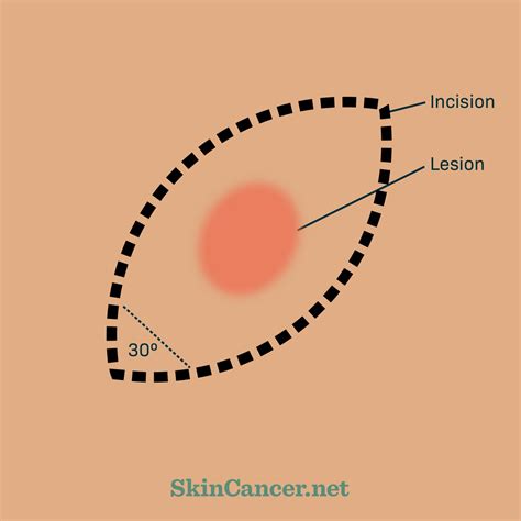 What You Should Know About Excision Surgery for Skin Cancer