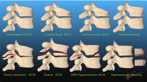 Spine Fracture Classification- 2019 | UW Emergency Radiology