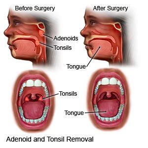 tonsil removal surgery - Jeffrey Decarvalho