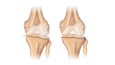 Knee Osteotomy | Knee Surgeon | Minnesota