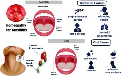 Tonsils