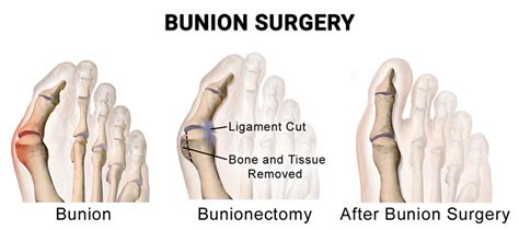 Bunion Surgery NJ | Clifton Best Bunion Removal Surgeon