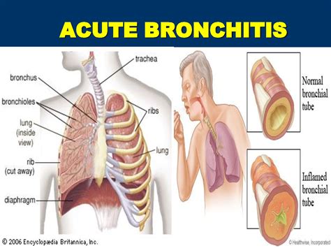 Acute Bronchitis | healze.com