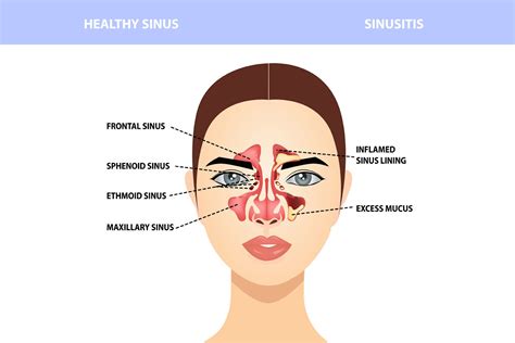 Maxillary Sinus Problems