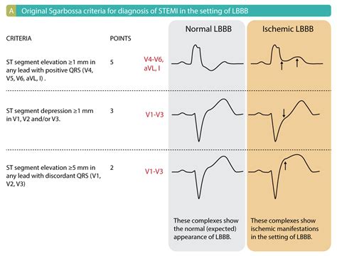 Left Bundle Branch Block Ecg