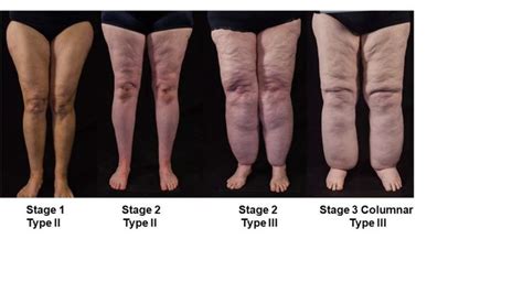 Subcutaneous Adipose Tissue Diseases: Dercum Disease, Lipedema ...