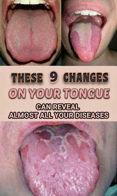 Be Aware Of THIS: These 9 Changes On Your Tongue Reveal Almost All Your ...