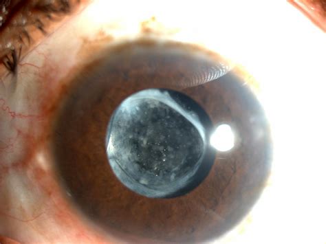 Yag Capsulotomy for Posterior Capsular Opacification » Eye Care ...