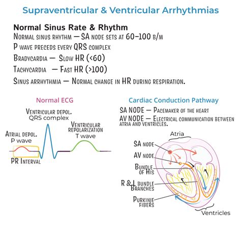 Clinical Pathology Glossary: Arrhythmias - Supraventricular | ditki ...