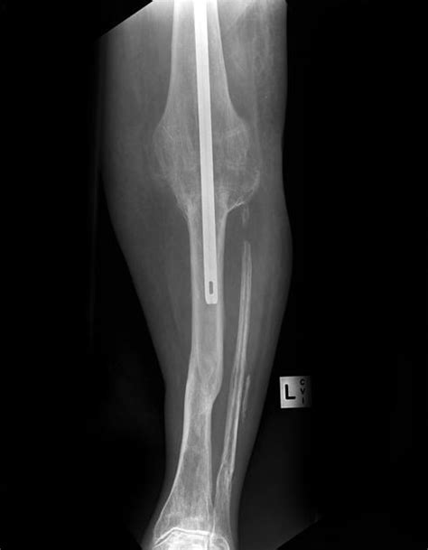 Knee Arthrodesis - Indications and Procedure | Bone and Spine