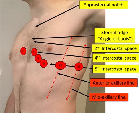 Midclavicular Line 5th Intercostal Space