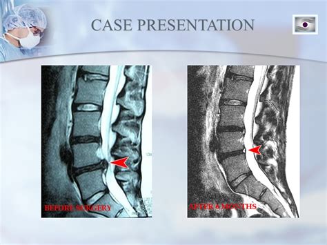 Dr. Luis Lombardi-L4/L5 Herniated Disc - Doctor Luis Lombardi