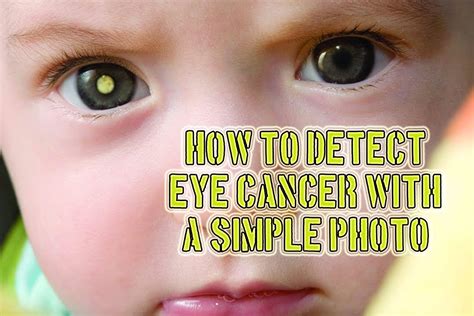 How Can You Tell If You Have Eye Cancer - CancerWalls