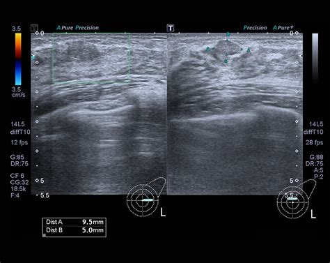 Breast Ultrasound and How It Is Used To Fight Against Breast Cancer - WCUI