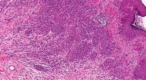 Spitz nevus | Ottawa Atlas of Pathology