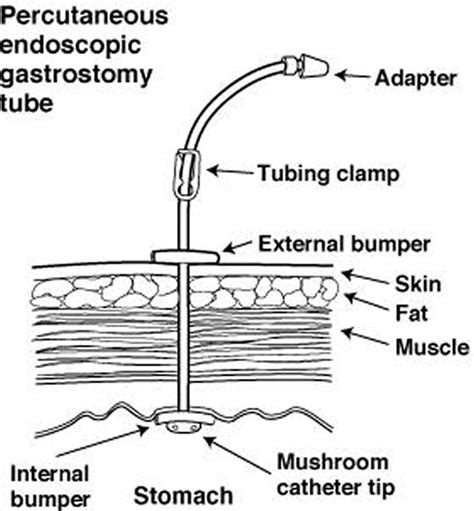 PEG Tube - Placement, Removal, Replacement, Complications