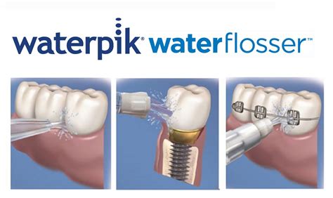 Waterpik Water Flosser now available from Tesco - British Dental Nurses ...