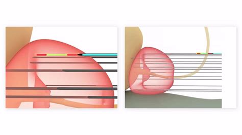 Brachytherapy For Prostate Cancer | Products | Elekta