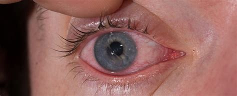 Symptoms of a Scratched Cornea - Eye Center of Texas