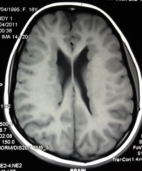 Radiodiagnosis - Imaging is Amazing-Interesting cases: Gray matter ...