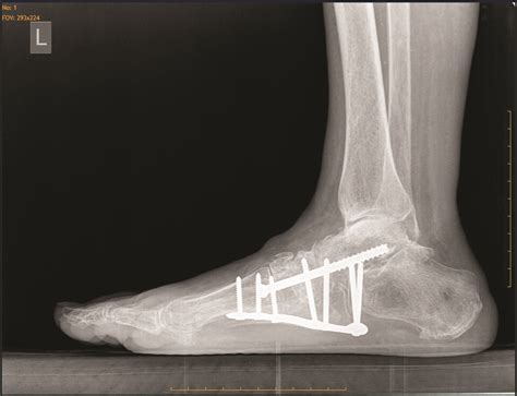 Charcot Foot Reconstruction