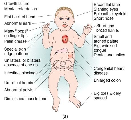 Down Syndrome | Inspiration Center