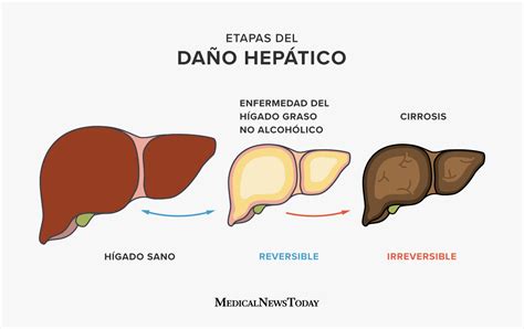 Enfermedad del hígado graso: Síntomas, causas, riesgos y tratamiento