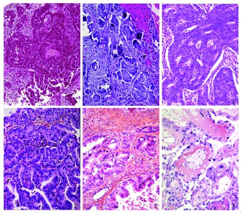 Histopathology of ovarian epithelial tumors. A, high-grade serous ...